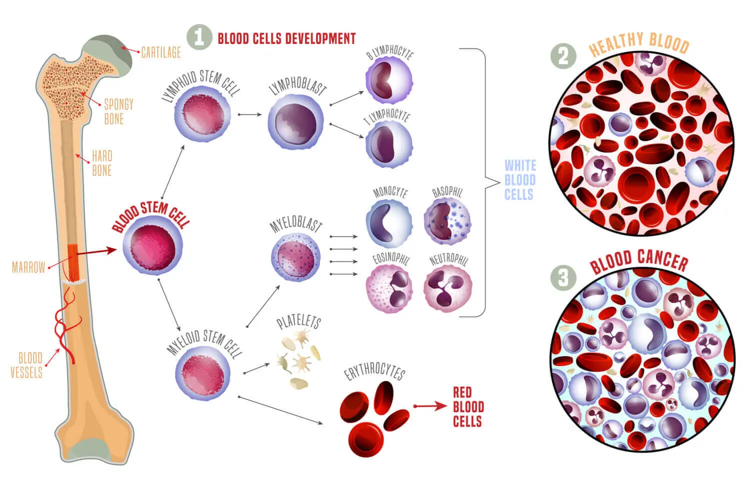 Causes of Leukaemia