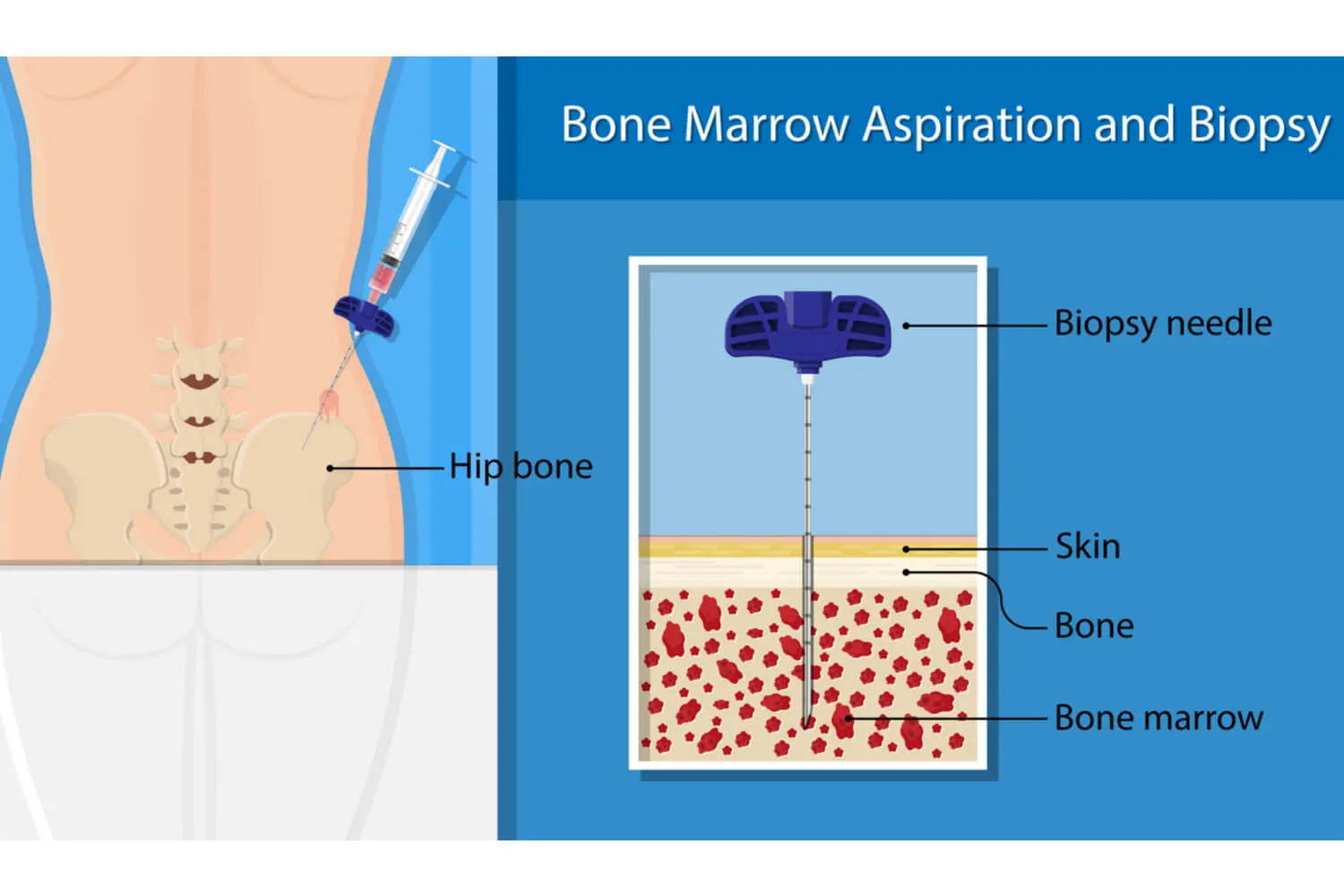 Bone Marrow Aspiration