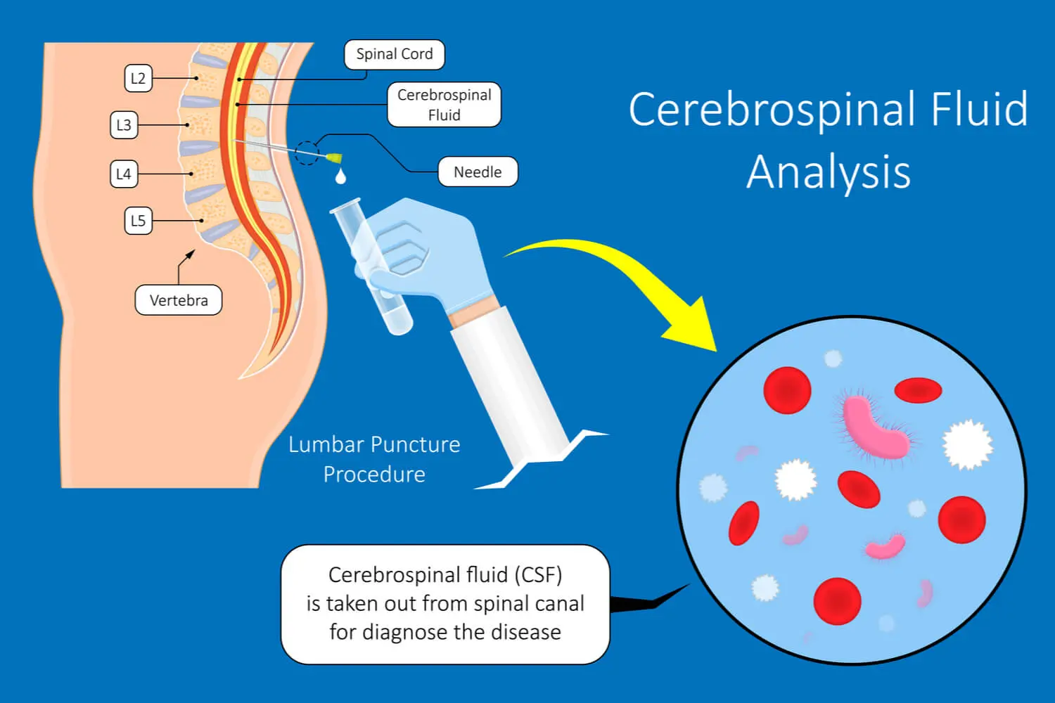 CSF Analysis